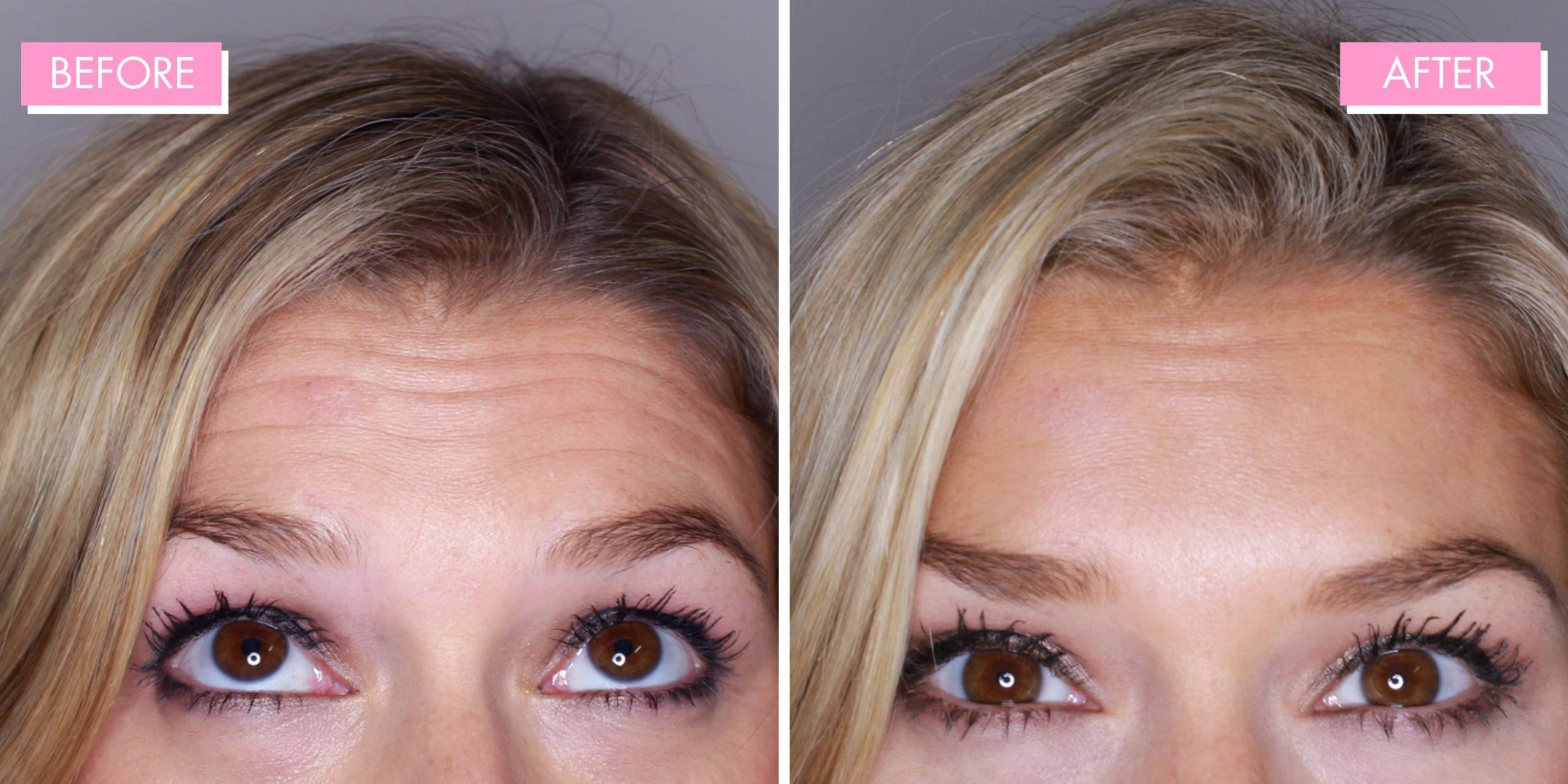 Anti-Wrinkle Injections Review -  things I learnt